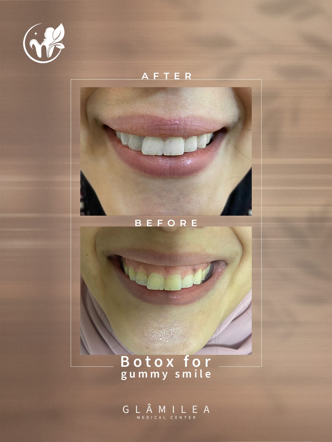 Scaling & Polishing