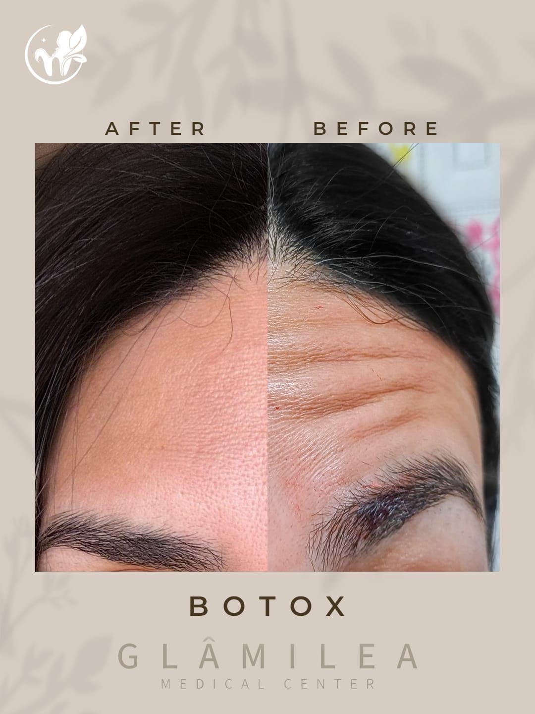 Anti-Aging Tightening Treatment