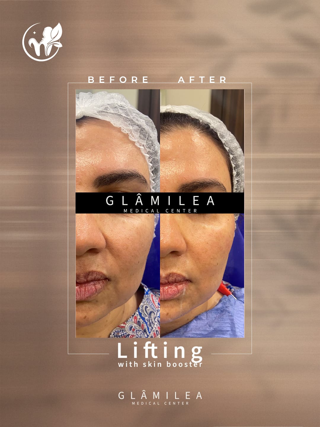 Enhance your natural beauty with our safe and effective Botox and dermal filler treatments
